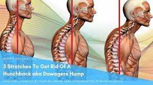 Buffalo hump refers to an unsightly lump of fat that develops at the top of the back between the shoulders. Dowager Hump Kyphosis Buffalo Thoracic Humps Santa Barbara Deep Tissue Riktr Pro Massage Nicola Lmt