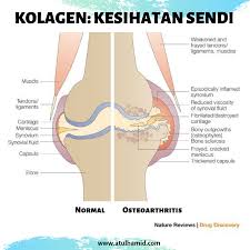 Sakit kepala sebelah kanan yang ringan umumnya bisa sembuh dalam hitungan menit sampai jam. Sakit Sendi Lutut Punca Siapa Berisiko Dan Cara Hilangkannya Atul Hamid