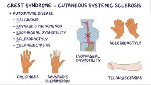 Image result for Systemic Sclerosis