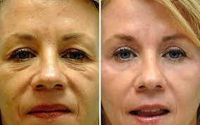 Maybe you would like to learn more about one of these? Blepharoplasty Annapolis Eyelid Surgery Droopy Eyelid
