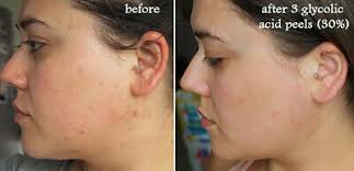 Glycolic Acid Chemical Face Peel Kit Medical Grade 100 Pure Acne Scars Wrinkles We Got It 4u