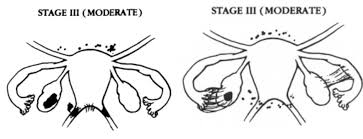 Endometriosis Symptoms Causes And Treatment