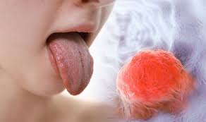 Image result for cancer tongue symptoms)