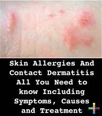 Skin Allergies And Contact Dermatitis All You Need To Know Including Symptoms Causes And Treatment In 2021 Skin Allergies Allergic Contact Dermatitis Contact Dermatitis