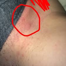 Ingrown hairs are more common in those with curly hair. Are Ingrown Hairs Hard Bumps Ingrown Hair