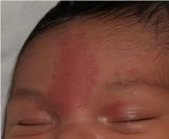 Image result for Nevus Simplex