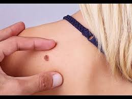 Click through the slideshow above for the signs and symptoms to look out for. Skin Cancer Signs And Symptoms Of Skin Cancer Youtube
