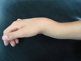 Check spelling or type a new query. Wrist Fracture Treatment Manchester Hand Wrist Surgery