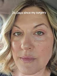 Stitch Coming Out Extraction The Same Day