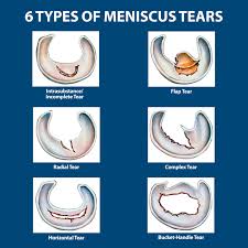 Surgical treatments include meniscectomy (partial or complete removal of the meniscus) or a repair of the tear. Meniscus Tears Florida Orthopaedic Institute