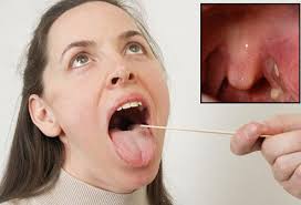 As time goes on you may or may not be able to see them; Tonsil Stones Picture Image On Medicinenet Com