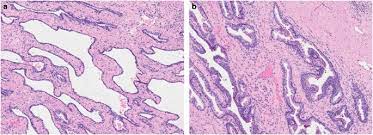 There are a number of different treatments doctors recommend. Treatment Effects In Prostate Cancer Modern Pathology