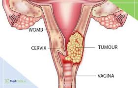 There are hpv tests that can be used to screen for cervical cancer. Survival Rate Of Cervical Cancer Mediglobus
