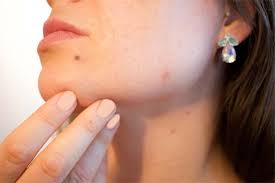 Skin cancer is by far the most common type of cancer. Specialized Mohs Surgery Fairfax Mohs Micrographic Surgical Procedure