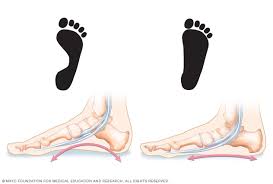 In the u.s., cancer is the second most common cause of death after heart disease. Flatfeet Symptoms And Causes Mayo Clinic