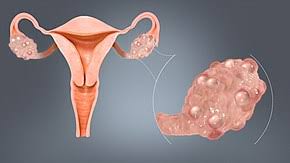 ovarian cyst wikipedia