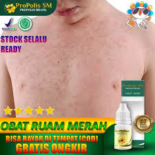 Candida juga bisa memburuk saat cuaca panas atau memakai pakaian ketat. Obat Kulit Ruam Merah Menghilangkan Bekas Ruam Bintik Bintik Merah Obat Gatal Kulit Obat Campak Campak