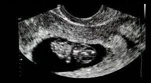 Clinica Bb Embarazo De 11 Semanas