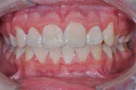 Stained, yellowed teeth can be a real bummer for your confidence, especially if you spend a lot the concentration of hydrogen peroxide used to bleach hair is much higher than the kind you'll make at home to help remove the coffee stains on your teeth. White Stains On Teeth Reddit Teethwalls