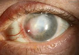 Aug 28, 2020 · fungal keratitis. Herpes Simplex Keratitis