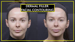 The old contour and highlighting trends were about changing your whole face to look a certain way, but now it's about embracing your natural shape and giving. All About Facial Contouring With Dermal Fillers Youtube