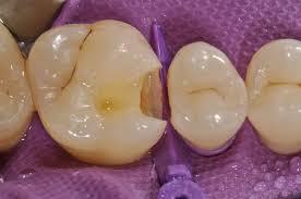 Show an inverse relationship between eating foods high in vitamin d and calcium, like yogurt, and cavities in young children. Case 349 Tam Dental Group