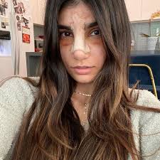 3 days left, help get mia to the next round. Mia Khalifa Faz Novo Procedimento Estetico Veja Resultado Jornal De Brasilia