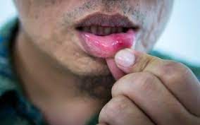 It is more common on the lower lip. Lip Cancer Signs And Symptoms