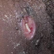 Image result for chancroid