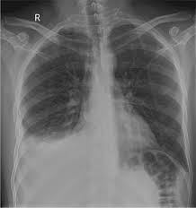 Surgical thoracostomy tube placement and radiologically guided catheter drainage are standard therapy for loculated pleural fluid collections. An Interesting Case Of Undiagnosed Pleural Effusion European Respiratory Society