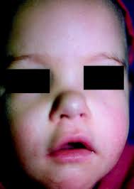 Lumps and bumps in neonates and infants