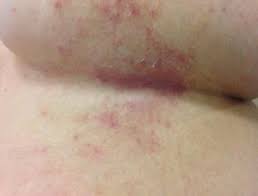 Image result for heat rash under breasts