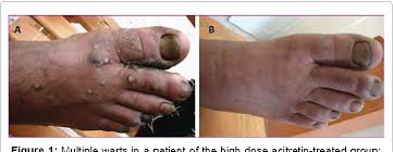 Treatment of recalcitrant viral warts with pulsed dye laser. Pdf Evaluation Of Acitretin In The Treatment Of Multiple Recalcitrant Common Warts A Pilot Study Semantic Scholar