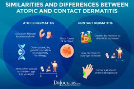 Eczema Symptoms Causes Support Strategies Drjockers Com Atopic Dermatitis Eczema Atopic Eczema