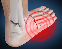 Foot tendinitis is a very common cause of pain due to irritation or inflammation in tendons of the foot after overuse or injury. Lateral Foot Pain Max Remedial Massage And Therapy