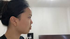 TED selepas iodin radioaktif : r/gravesdisease