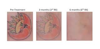 The tattoo is 3 years old. Tattoo Removal Redefine Beauty Aesthetics