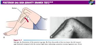 Image result for PCL Sag Test