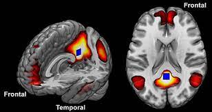 Asperger's syndrome (also known as just asperger's) was once its own diagnosis. Frontiers Differences In Cortical Structure And Functional Mri Connectivity In High Functioning Autism Neurology