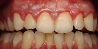 Image result for Gingivitis