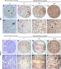 Malignant pleural mesothelioma (mpm) is a deadly disease with few systemic treatment options. Targeting Yap In Malignant Pleural Mesothelioma Zhang 2017 Journal Of Cellular And Molecular Medicine Wiley Online Library