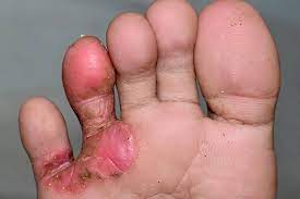 6 Home Care Tips For Athlete S Foot In Children