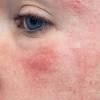 The best face masks for reducing redness. Https Encrypted Tbn0 Gstatic Com Images Q Tbn And9gcszjbwwcfbzjf6grpidhaou8ovvxdsanzczjgqj1fzrsnffkicd Usqp Cau