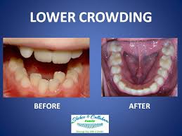 Braces Before And After Lower Crowding Braces Before And After Braces Invisalign Braces
