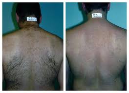 Our doctors have been at this location for over 20 years and we have performed thousands of hair removal laser treatments. Laser Hair Removal For Men In Pittsburgh Happel Center