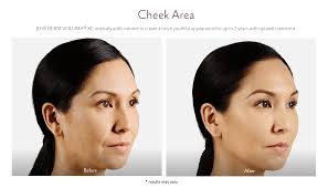 Avoid extreme sun exposure, uv light, freezing temperatures and saunas for 2 weeks. Juvederm Before And After Pictures Juvederm Westport Ct