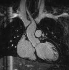 Image result for Cardiac MRI