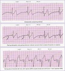 Image result for Transcutaneous Pacing