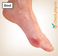 Image result for gout