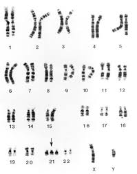 Down Syndrome Trisomy 21 Pediatrics Msd Manual